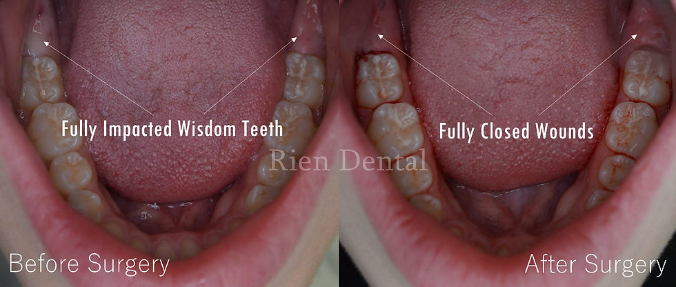 wisdom teeth extraction