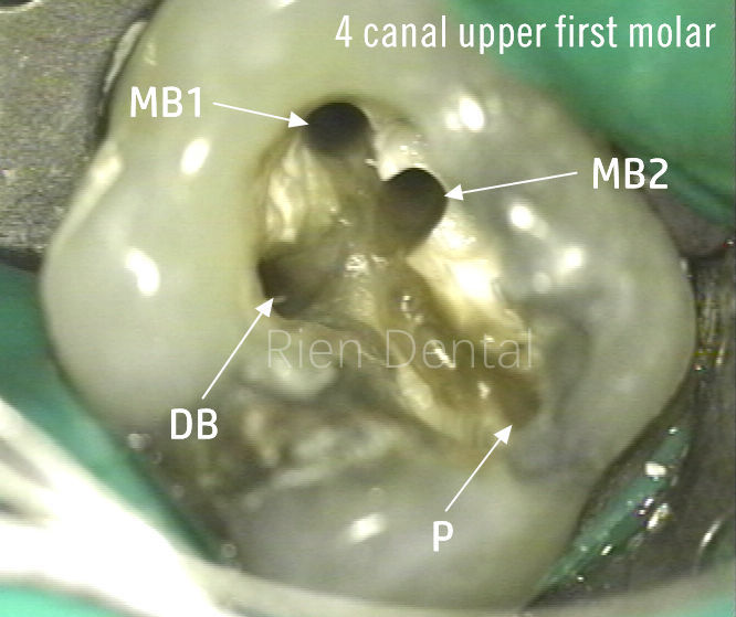 Maxillary first molar with MB2