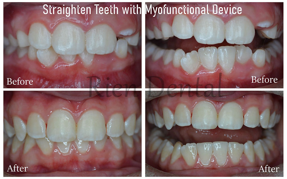 straighten teeth with myofunctional device
