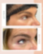 Avant/après Yeux