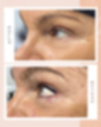 Avant/après Yeux
