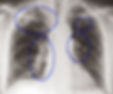 Silicosis 1