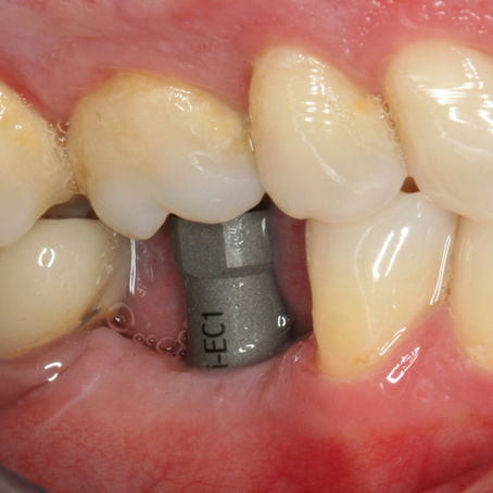 Tips para la utilización del Scan Body