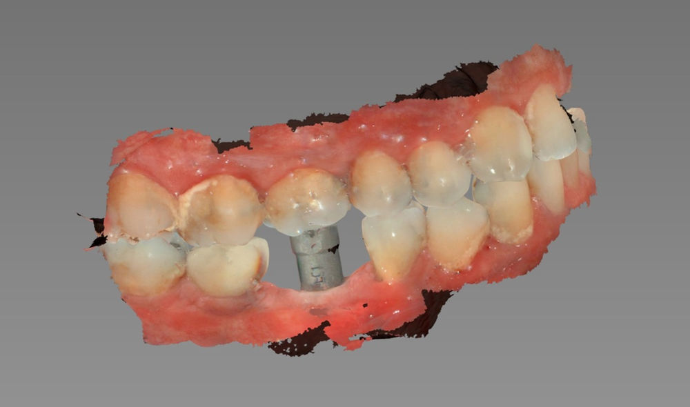 Tips para la utilización del Scan Body