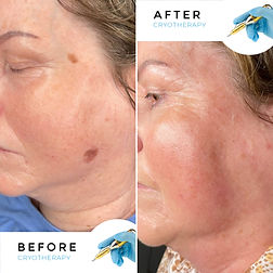 Cryotherapy_Results_MWSKinStudio-1024x1024.jpg