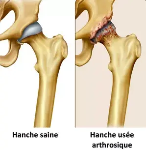 Arthrose : ce que l'ostéopathie peut apporter et ses limites