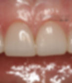 Acabados estéticos microscópicos sin limar los dientes.