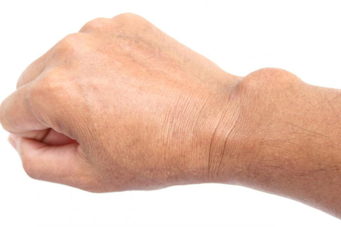 What is a Ganglion Cyst?