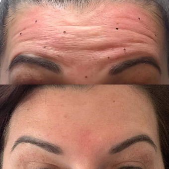 Anti-wrinkle Injections