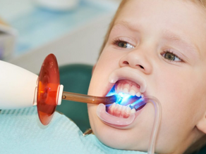 La sigillatura dentale: prevenzione efficace per la salute orale dei bambini