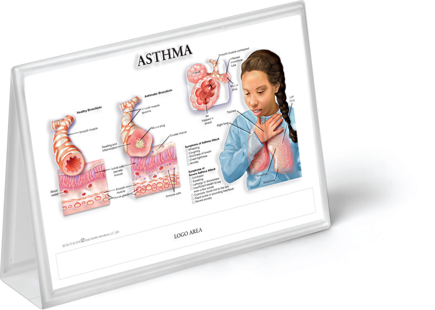 Asthma - Anatomical Tent Chart