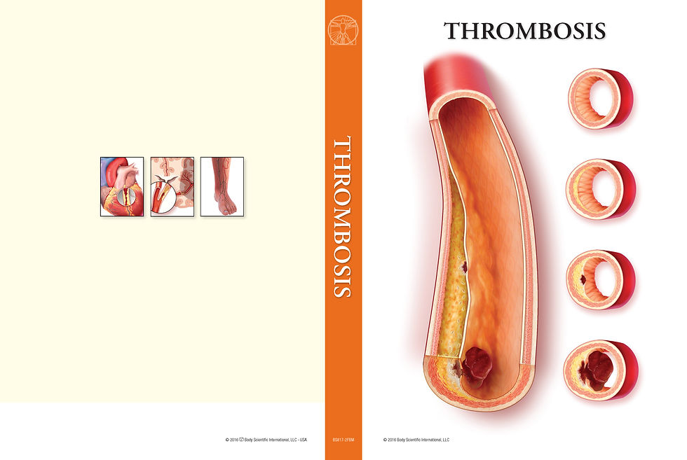 Thumbnail: Thrombosis - Medical Book (Bi-fold)