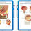 Benign prostatic hyperplasia (BPH) - Wipe-off Easel