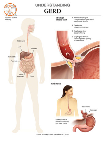 Gerd Body System GERD - Anatomical Wall Chart | BSI Catalog