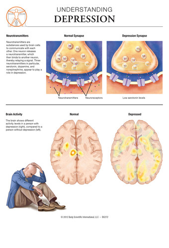 Depression - Anatomical Wall Chart | BSI Catalog