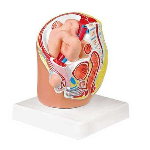 Indirect Inguinal Hernia