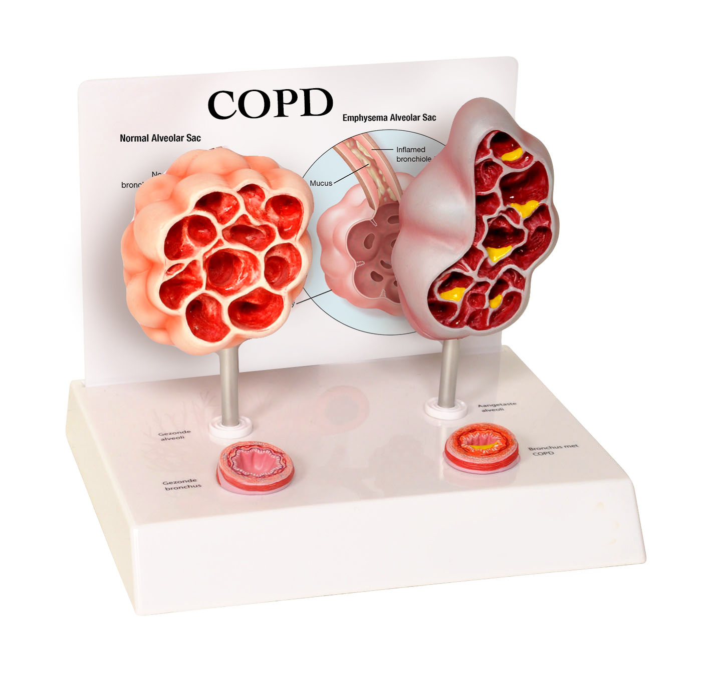 COPD - Model