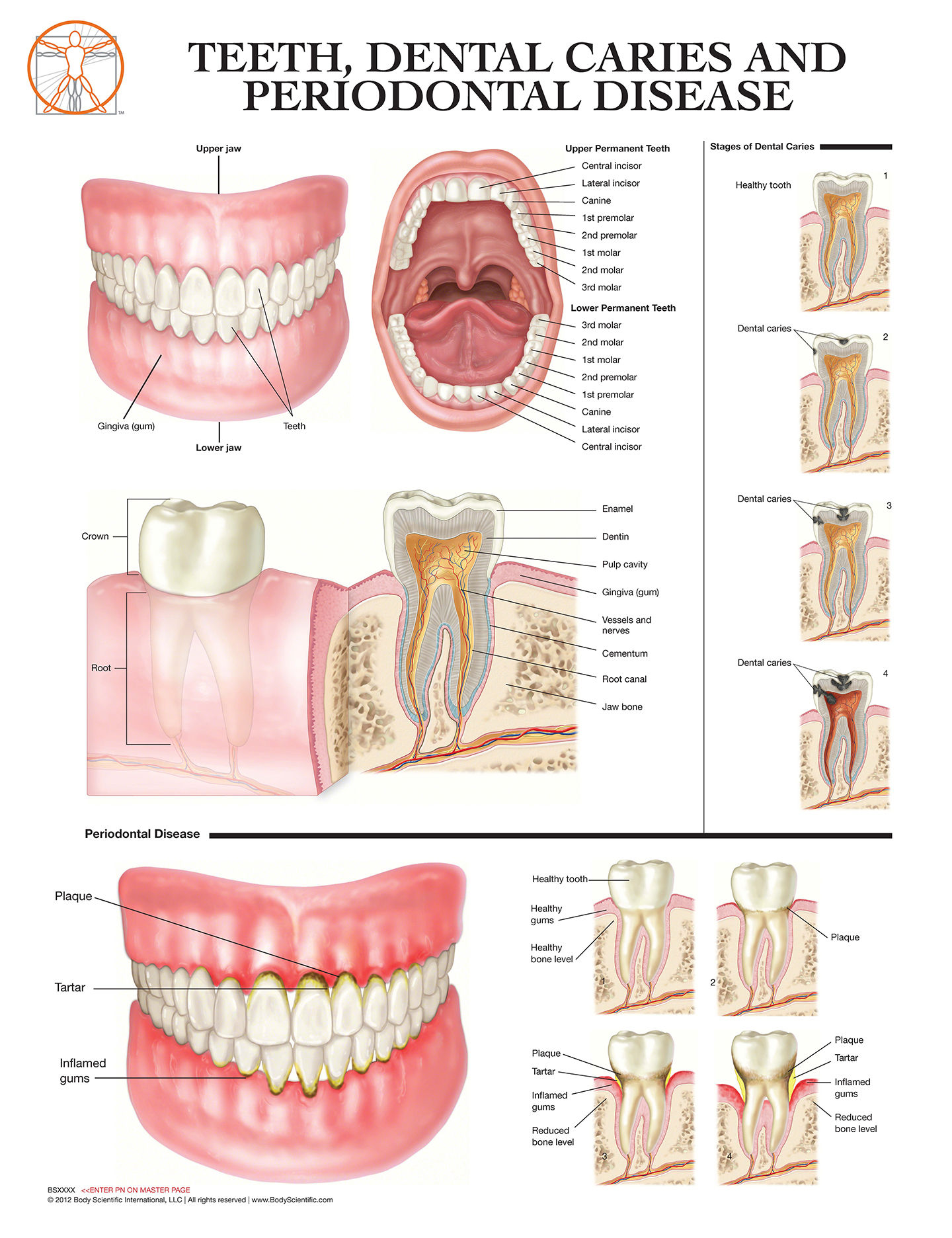 Teeth, Dental Caries, and Periodontal Disease - Anatomical Wall Chart