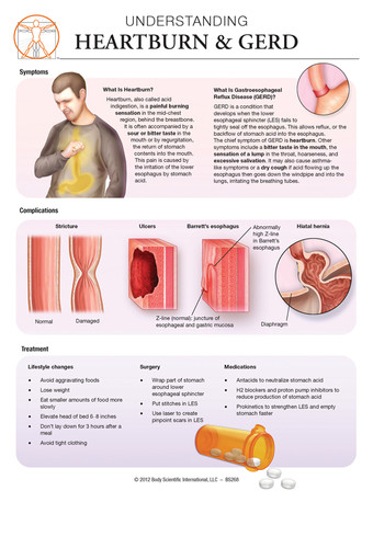 Heartburn And GERD Anatomical Wall Chart BSI Catalog heartburn-and-gerd-anatomical-wall-chart-bsi-catalog