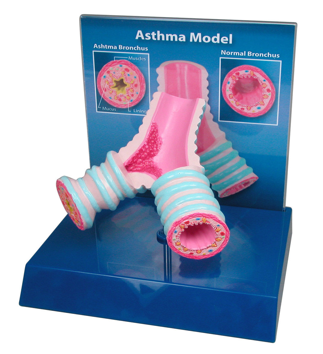 Asthma Bronchi - Model