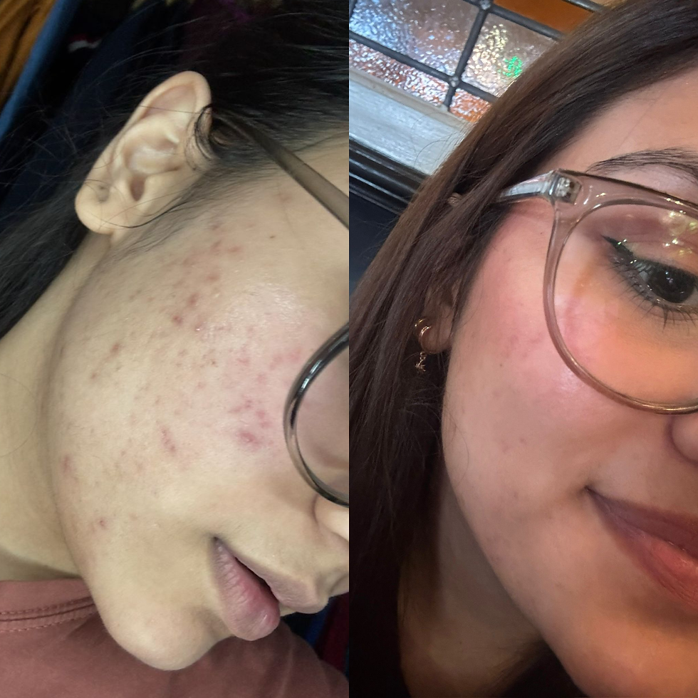Before and after skin treatment results showing visible improvement at Kavita Beauty London