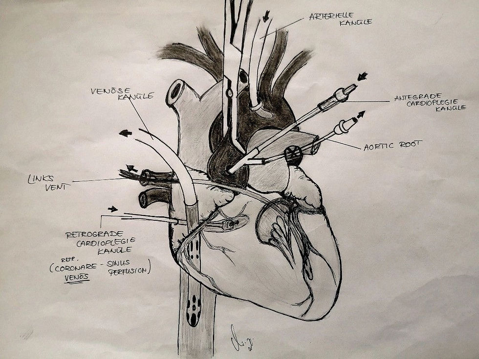 Corazón con cánulas para la derivación cardiopulmonar (Circulación extracorpórea)