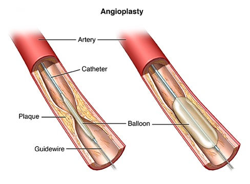 detail of angioplasty procedure