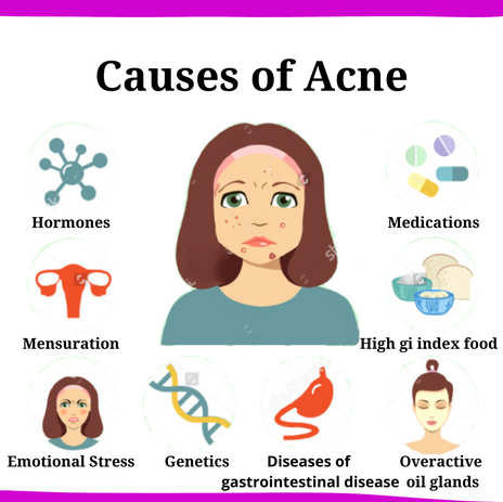 Causes of Acne