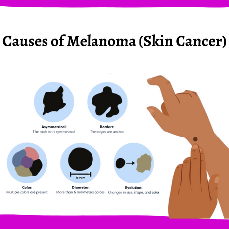 Causes of Melanoma