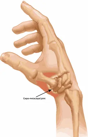 Thumb arthritis.webp