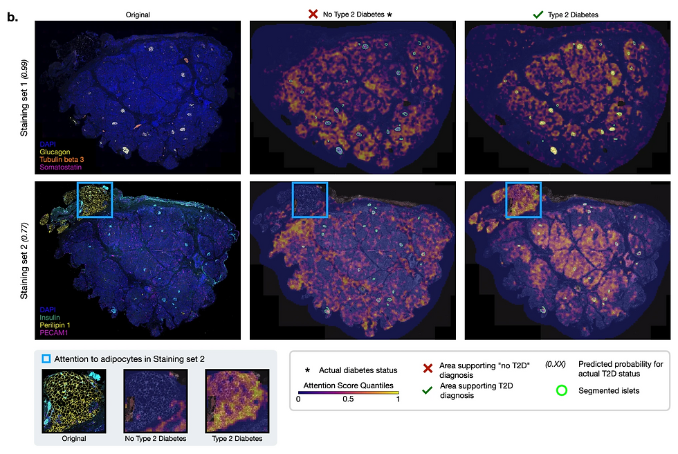 Heatmaps showing differences between patients with and without T2D