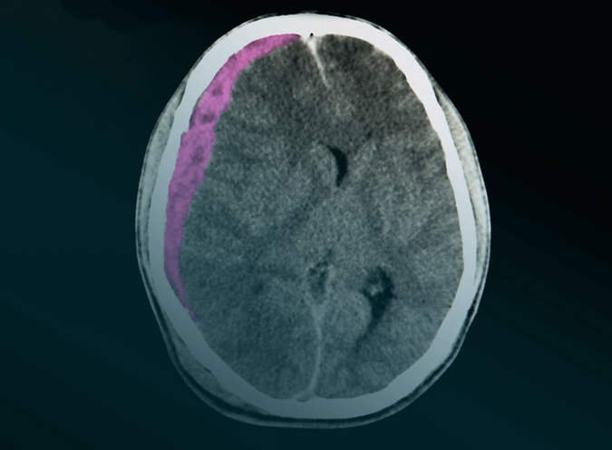 A CT scan of a subdural hematoma from a fall in a nursing home.