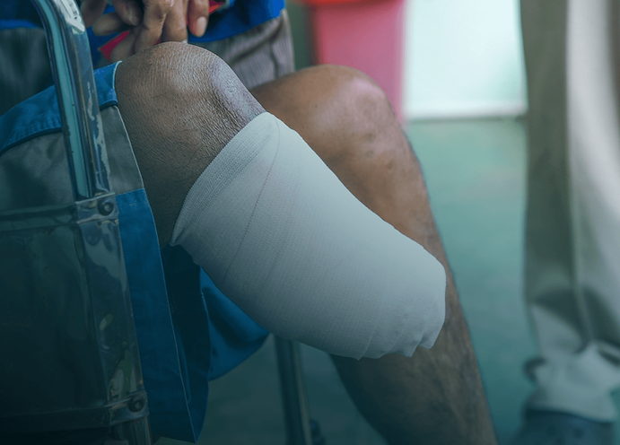 Below the knee amputation from nursing home neglect.