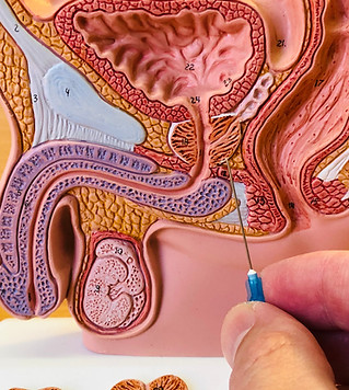 transperineal