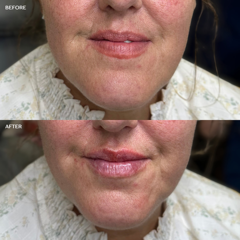 Lip Filler San Antonio, Texas