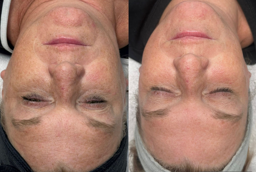 SkinPen Microneedling