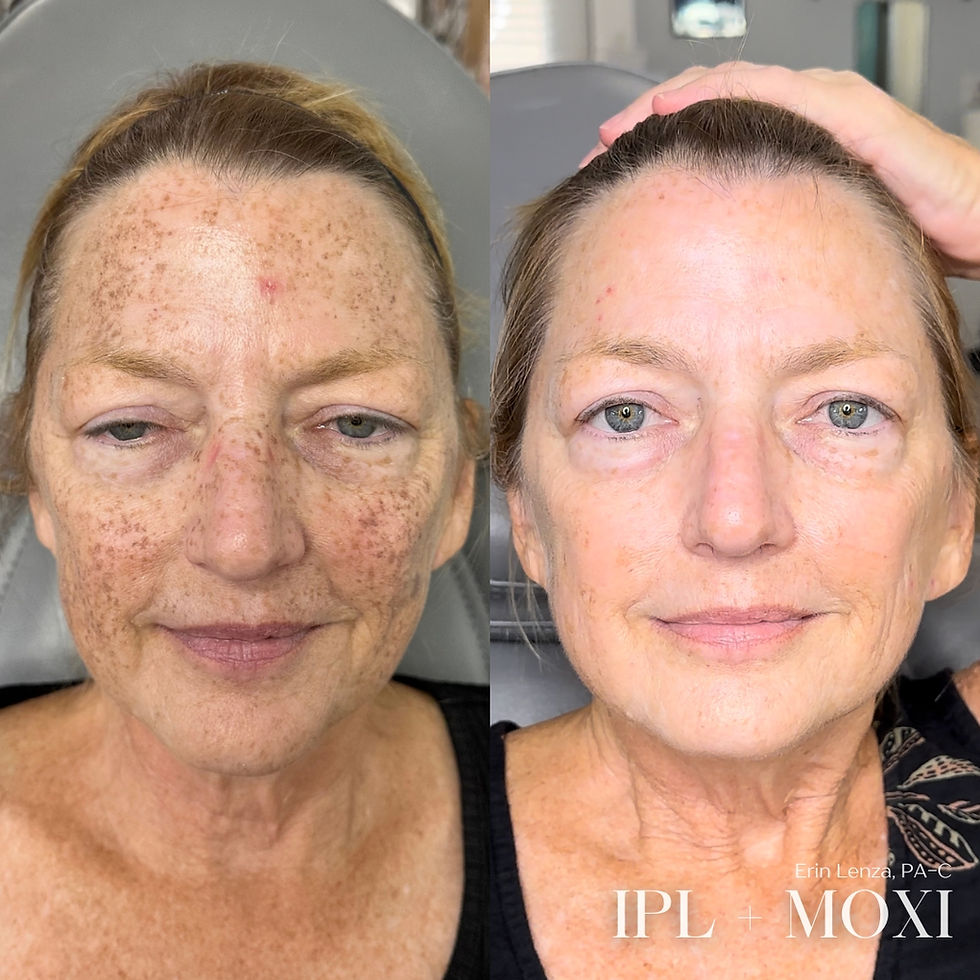 MOXI + IPL