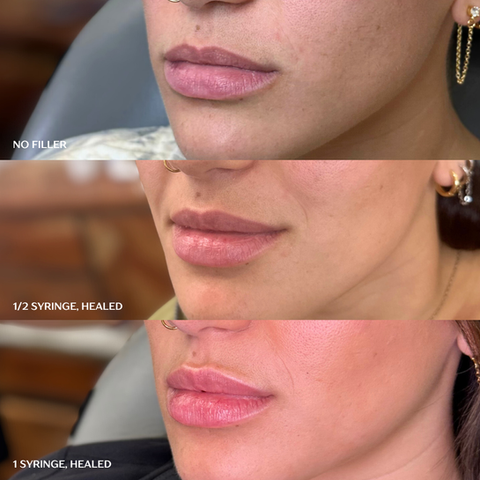Lip Filler San Antonio, Texas