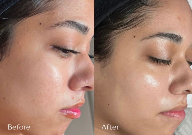 Comedonal Acne Treatment in San Antonio, Texas