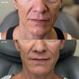 radiesse cheeks, Radiesse before and after, Radiesse San Antonio