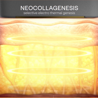 Skin before XERF (and neocollagenesis)
