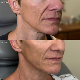 radiesse cheeks, Radiesse before and after, Radiesse San Antonio
