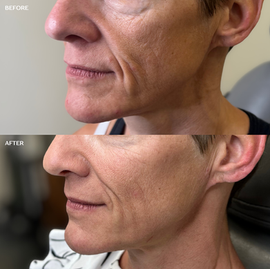 radiesse cheeks, Radiesse before and after, Radiesse San Antonio