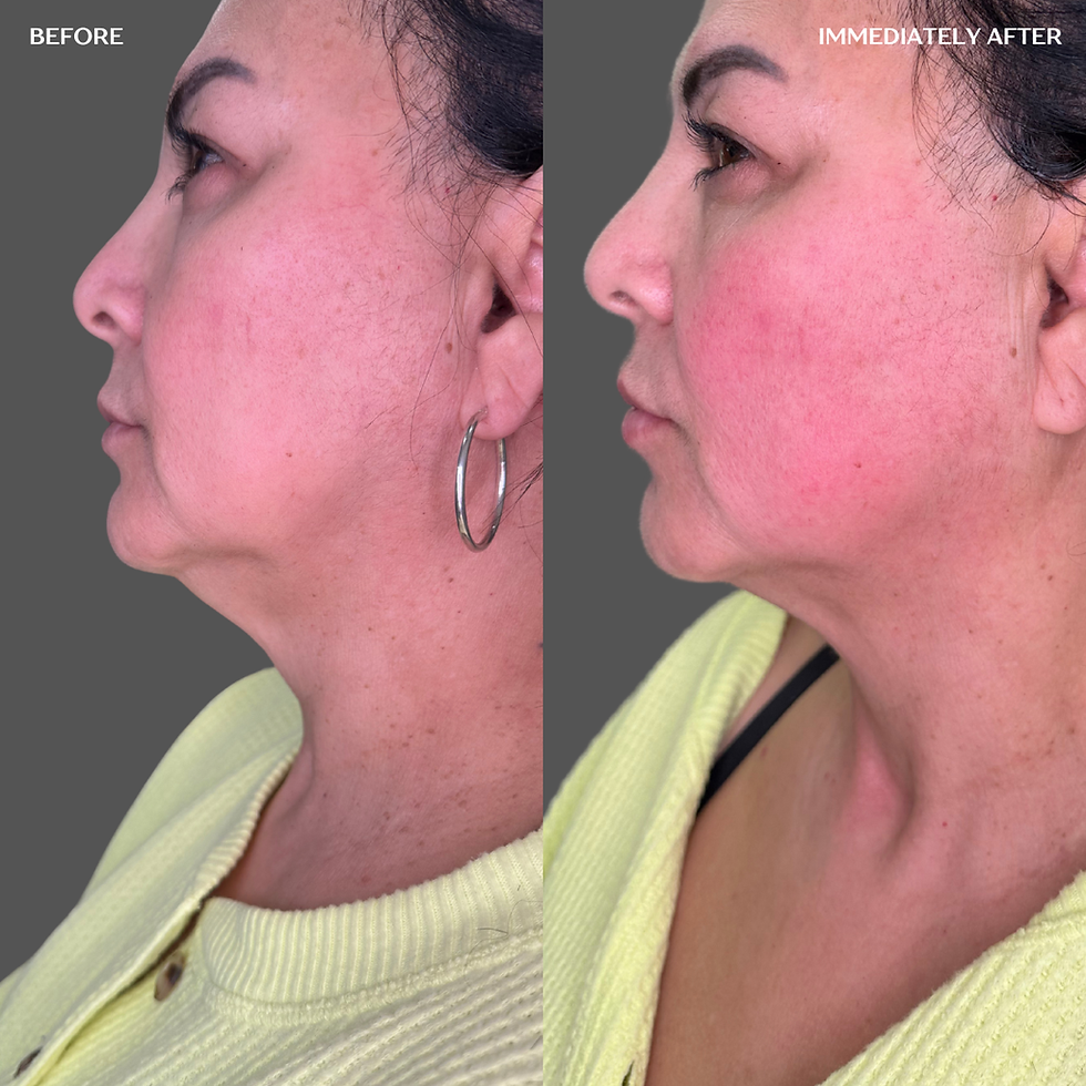 XERF Skin Tightening in San Antonio before and after