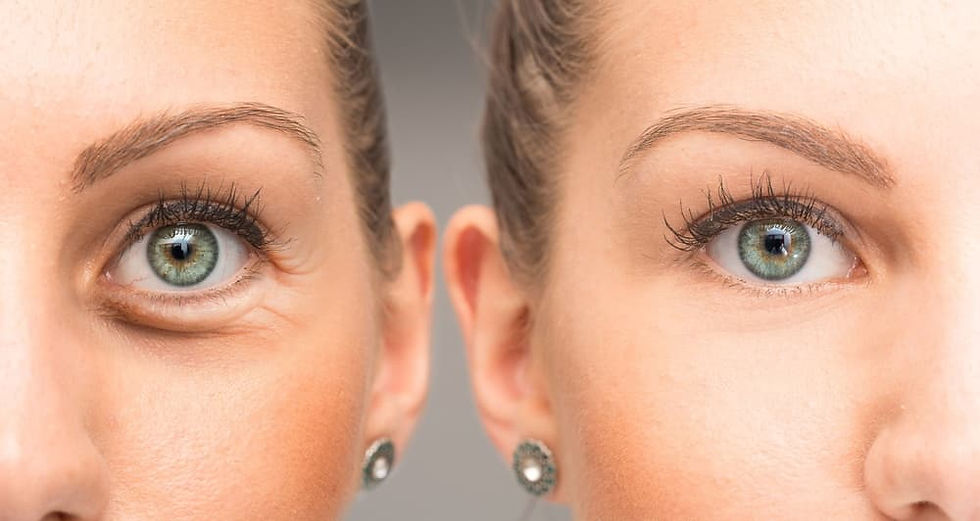 crows feet and botox treatment in houston texas.jpg