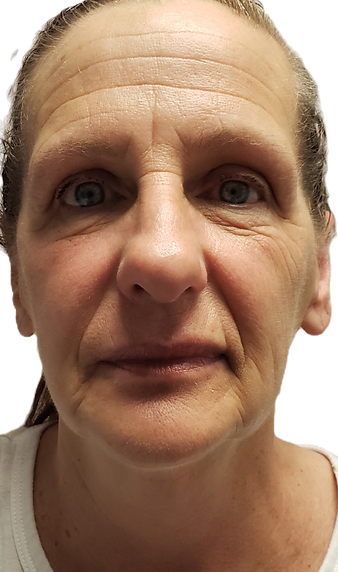 CryoFacial Before