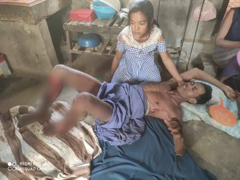 This man received severe burns on his legs from shelling by the Burma Army. 