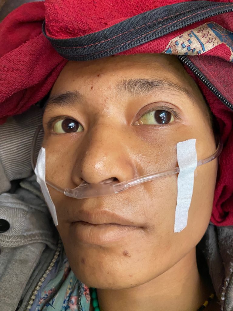 Jaundice seen in the patient’s eyes on admission.