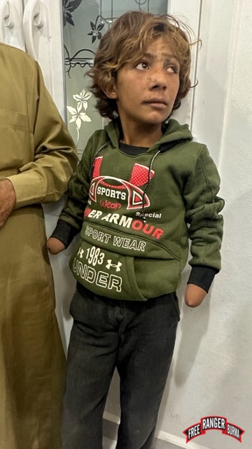 Boy who lost his hands and one eye to a landmine in Kobane.