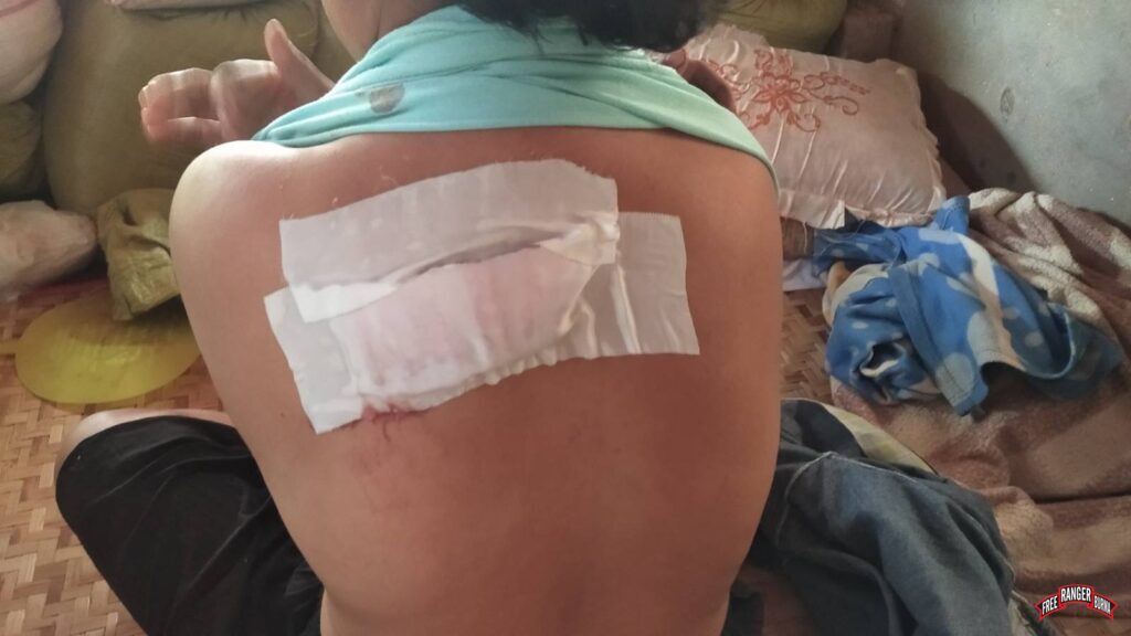 Aw Mu A Thaw’s wounds from the Burma Army mortar.